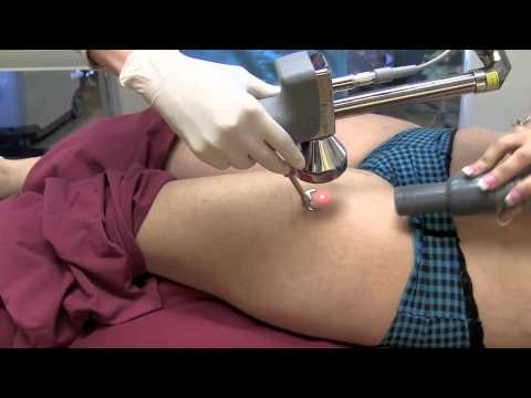 Surgery to Remove Stretch Marks